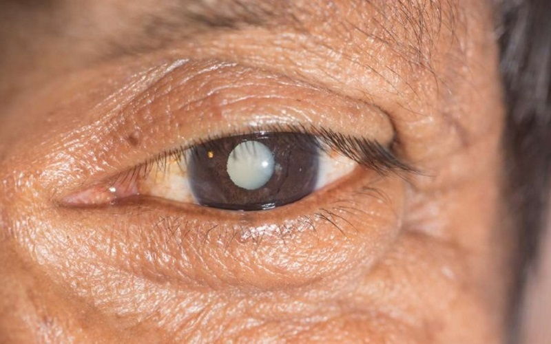 Cirugía de la catarata - Segmento anterior - enfermedades y patologías oculares (de los ojos)