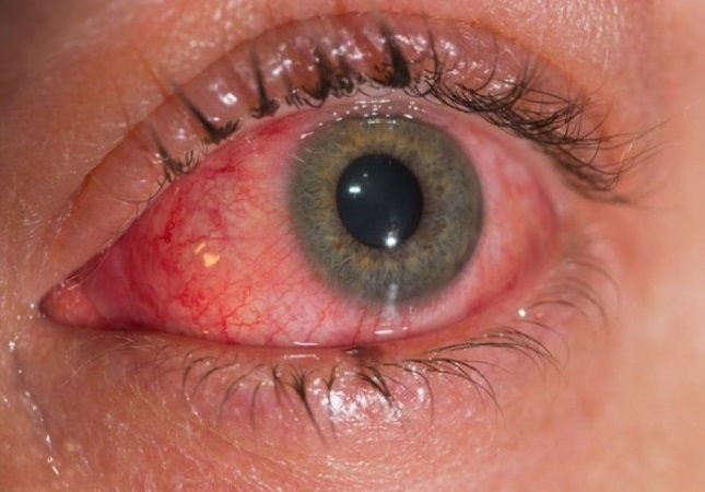 Artículo clínico y oftalmológico - Conjuntivitis alérgica en Margarita